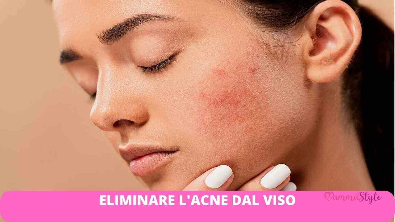 e-comparsa-lacne-sul-tuo-viso?-niente-panico:-segui-questi-step-e-andra-via-in-men-che-non-si-dica