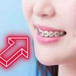 apparecchio-denti,-cosa-fare-se-si-stacca-una-piastrina-o-bracket:-niente-panico,-ecco-le-dritte