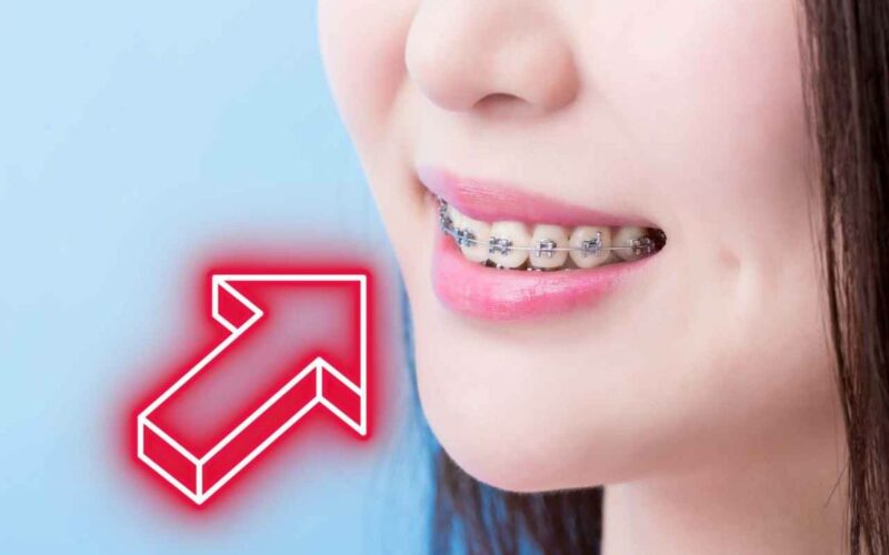 apparecchio-denti,-cosa-fare-se-si-stacca-una-piastrina-o-bracket:-niente-panico,-ecco-le-dritte