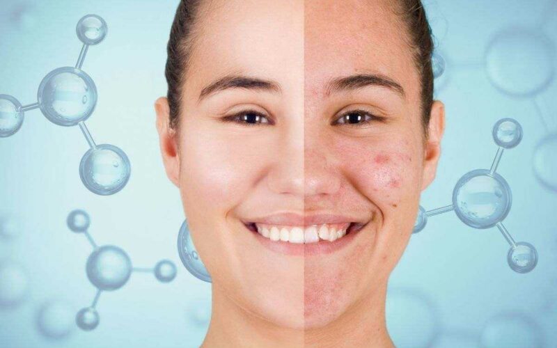 acne-addio:-gli-scienziati-scoprono-finalmente-la-molecola-che-la-cancella-per-sempre