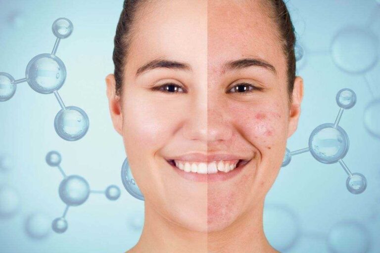 acne-addio:-gli-scienziati-scoprono-finalmente-la-molecola-che-la-cancella-per-sempre