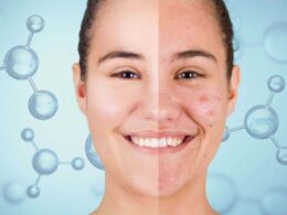 acne-addio:-gli-scienziati-scoprono-finalmente-la-molecola-che-la-cancella-per-sempre